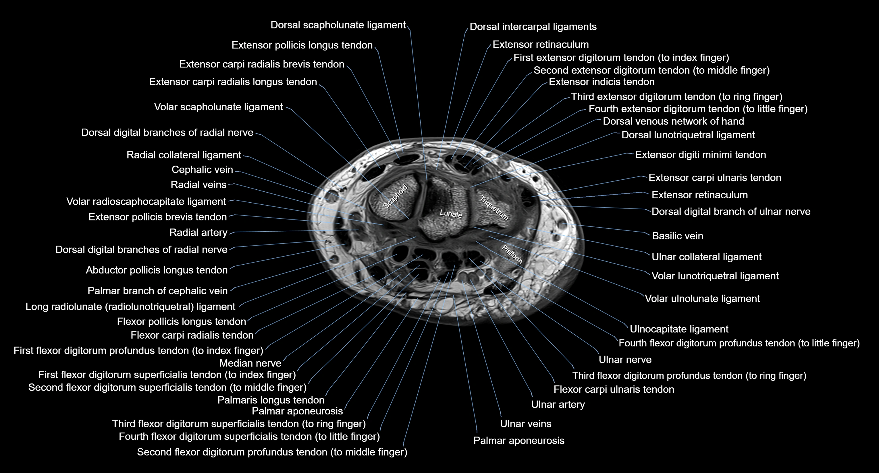 MRI wrist axial cross sectional anatomy 3T radiology  image-img-00001-00020.webp